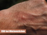 Hilft CBD bei Mueckenstichen / Insektenstichen